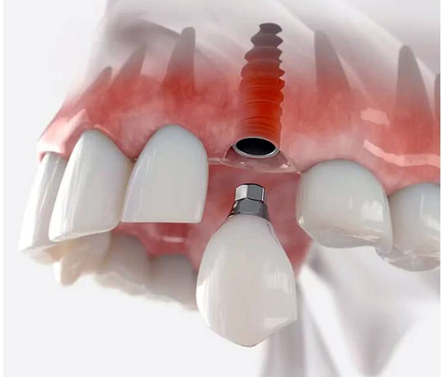 dental implants